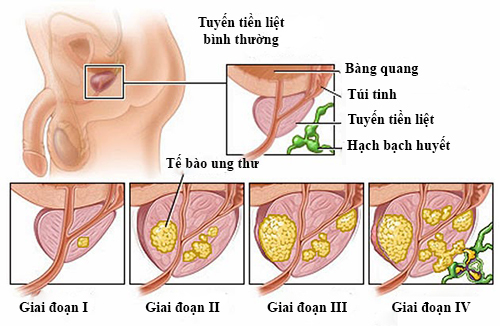 Các giai đoạn phát triển của ung thư tiền liệt tuyến